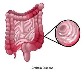 Ledford: Cracking IBD Mysteries