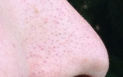 DiCorato: Our Lines of Defense: A Look into Nasal Immunity